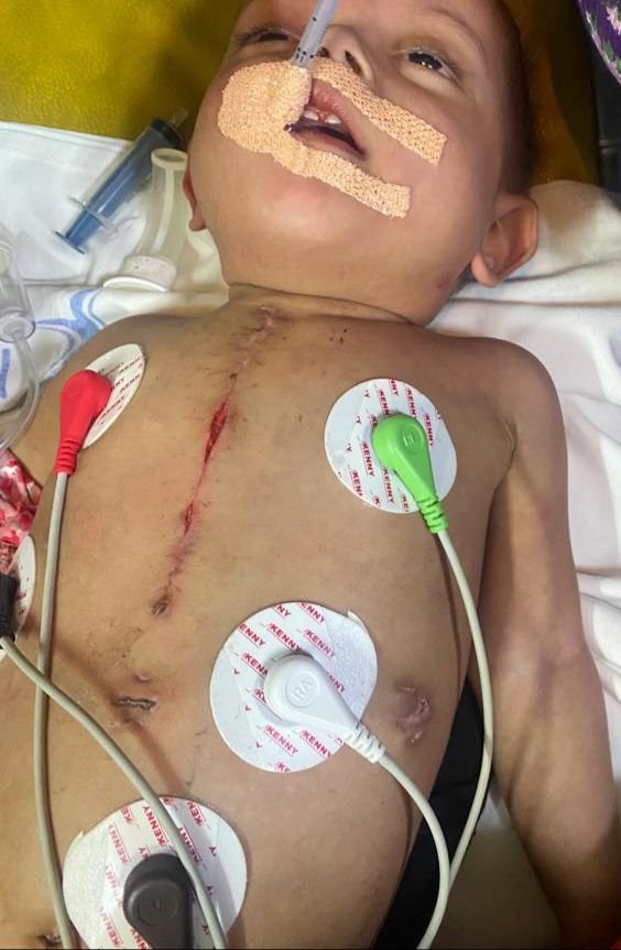 14-month-old attended by doctors onboard Vistara flight for heart ailment ‘in critical stage on ventilator’ say hospital