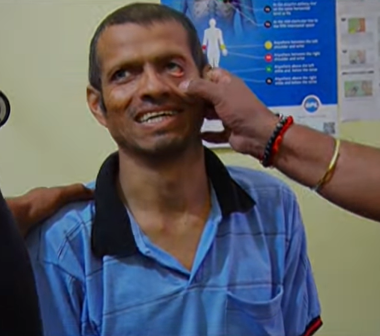 Karnataka: Mentally Ill Man Chained and Locked for Two Years by Family in Sugarcane Field Shed; Rescued by Officials in Uttara Kannada