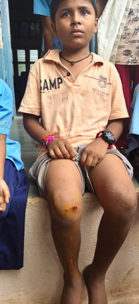 Bagalkot School Roof Concrete Collapses on Students at Mughalolli Tanda; Six Children Safe, Repairs Ordered